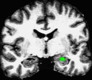 Coronal section through a human brain showing activation in the hippocampus during a memory experiment.  