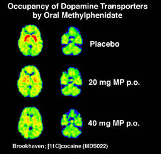 Brain scans showing the effect of the drug Ritalin.